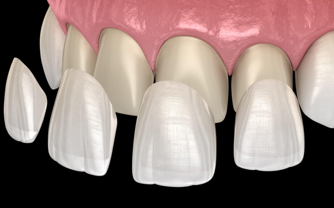 Dental Veneers Cost: Understand the Factors That Influence the Price