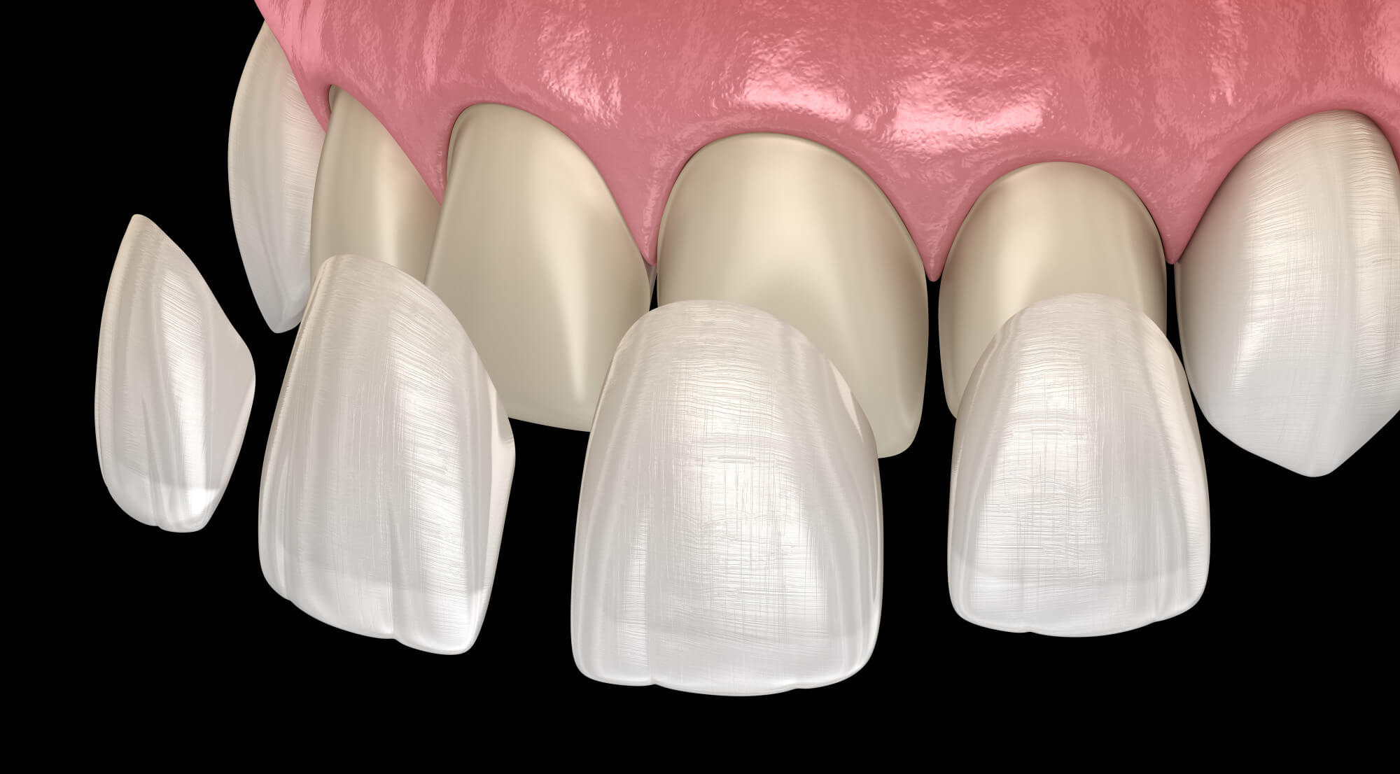 Porcelain Veneer Dentist