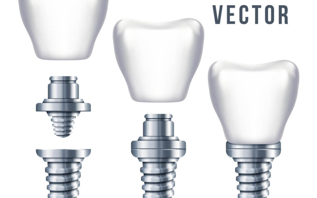 Do Dental Implants Hurt? Discover the Truth Behind the Process