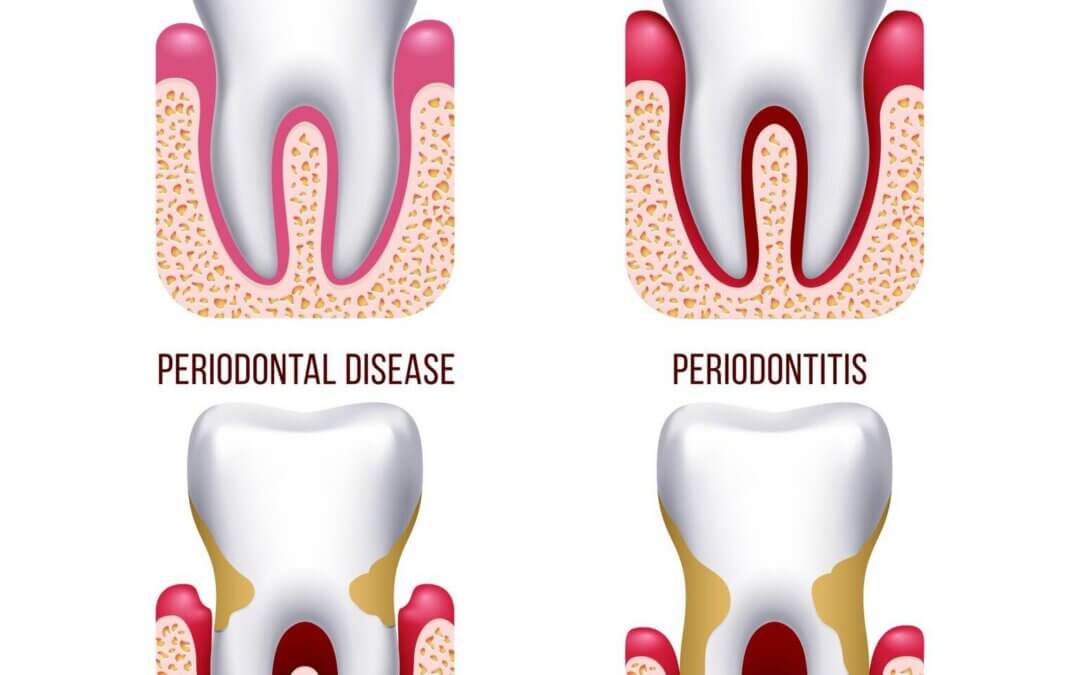 Veneers and Gum Disease: Are They Compatible?