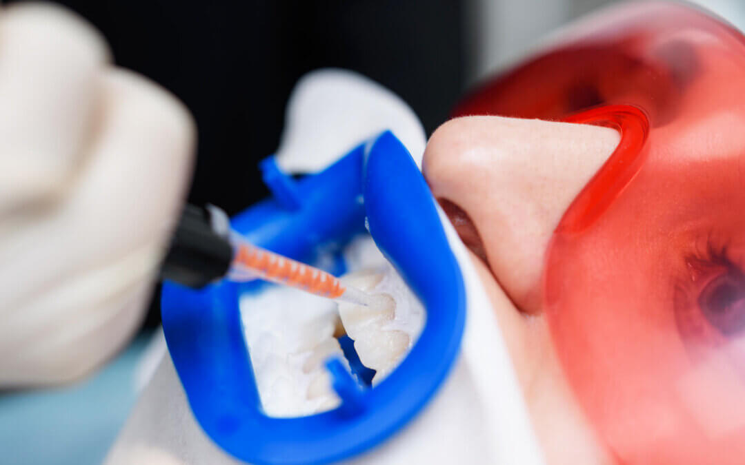 Say Goodbye to Teeth Discoloration: Your Guide to a Whiter Smile